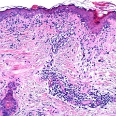 A-and-B-Skin-biopsy-showing-large-areas-of-epidermal-atrophy-rare-colloid-bodies-in_Q320.jpg